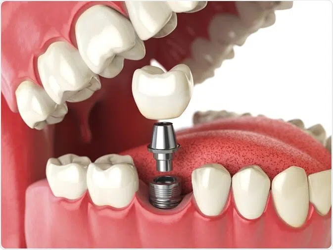 diagram of dental implants troy il