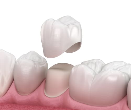 Example of a same-day dental crown using CEREC technology