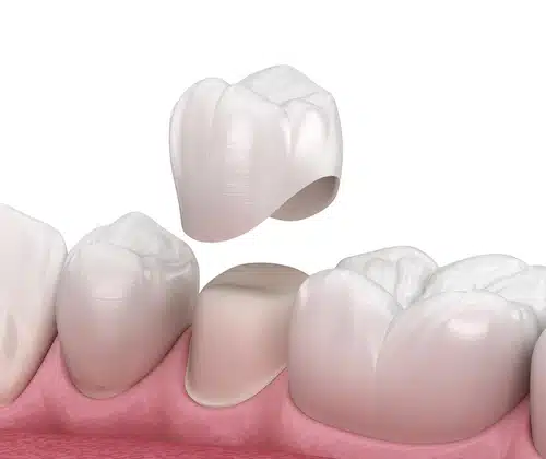 Example of a same-day dental crown using CEREC technology